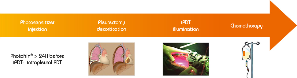 Roadmap of photodynamic therapy for malignant pleural mesothelioma